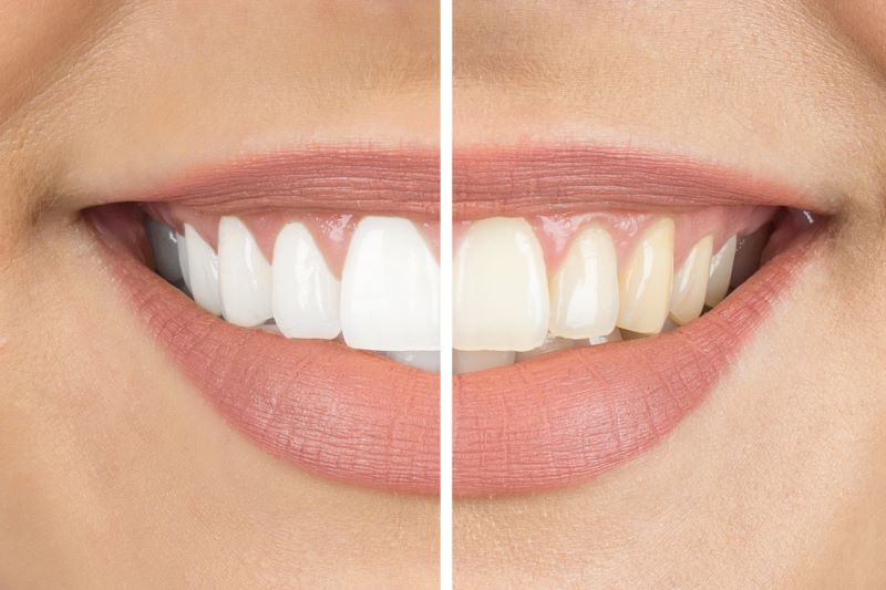 Bleaching Dr. Salfinger Tobias